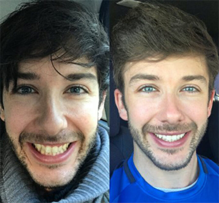 Invisalign Treatment - Before and After