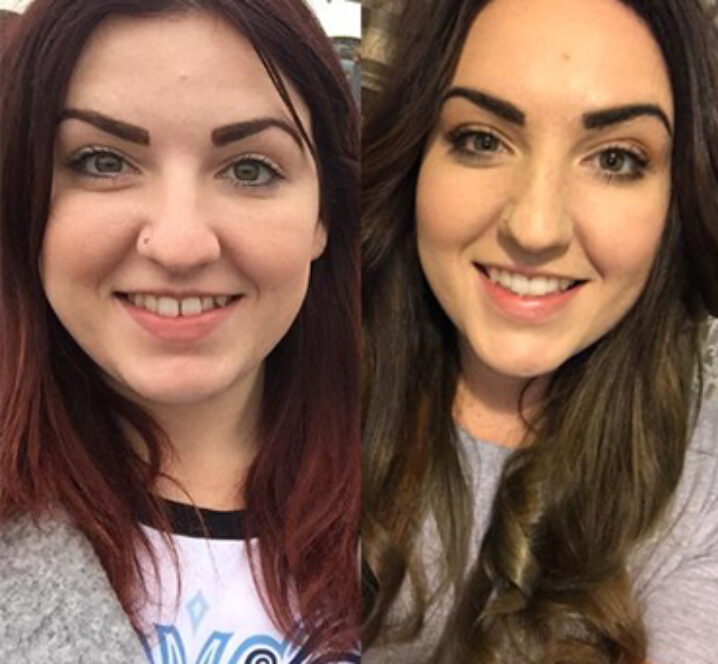 Invisalign Braces - Before and After