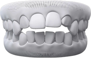 Open bite treatment