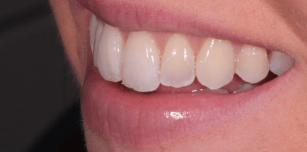 After - Pro Hygienist Dental 