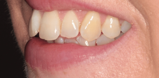 Before - Pro Hygienist Dental 