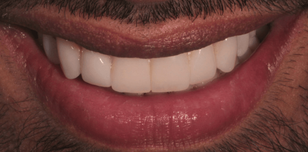 After - Pro Hygienist Dental 