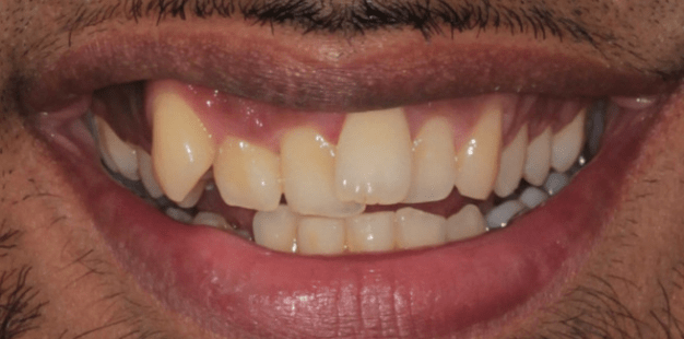 Before - Pro Hygienist Dental 