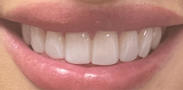 After - Pro Hygienist Dental 