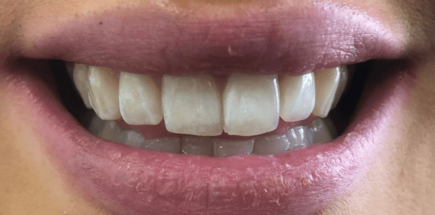 Before - Pro Hygienist Dental 