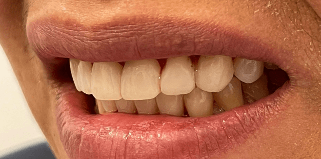After - Pro Hygienist Dental 