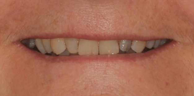 Before - Pro Hygienist Dental 