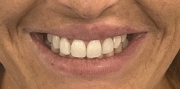 After - Pro Hygienist Dental 